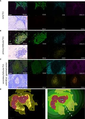 A Standardized Analysis of Tertiary Lymphoid Structures in Human Melanoma: Disease Progression- and Tumor Site-Associated Changes With Germinal Center Alteration